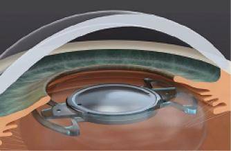 Precisight Multicomponent IOL