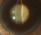 Dislocated Mature Black Cataract