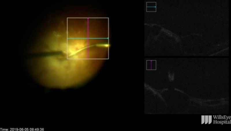 Creating Space With Flat Adherent Tractional Membranes thumbnail