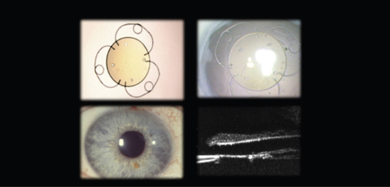 The Development and Impact of the Malyugin Ring