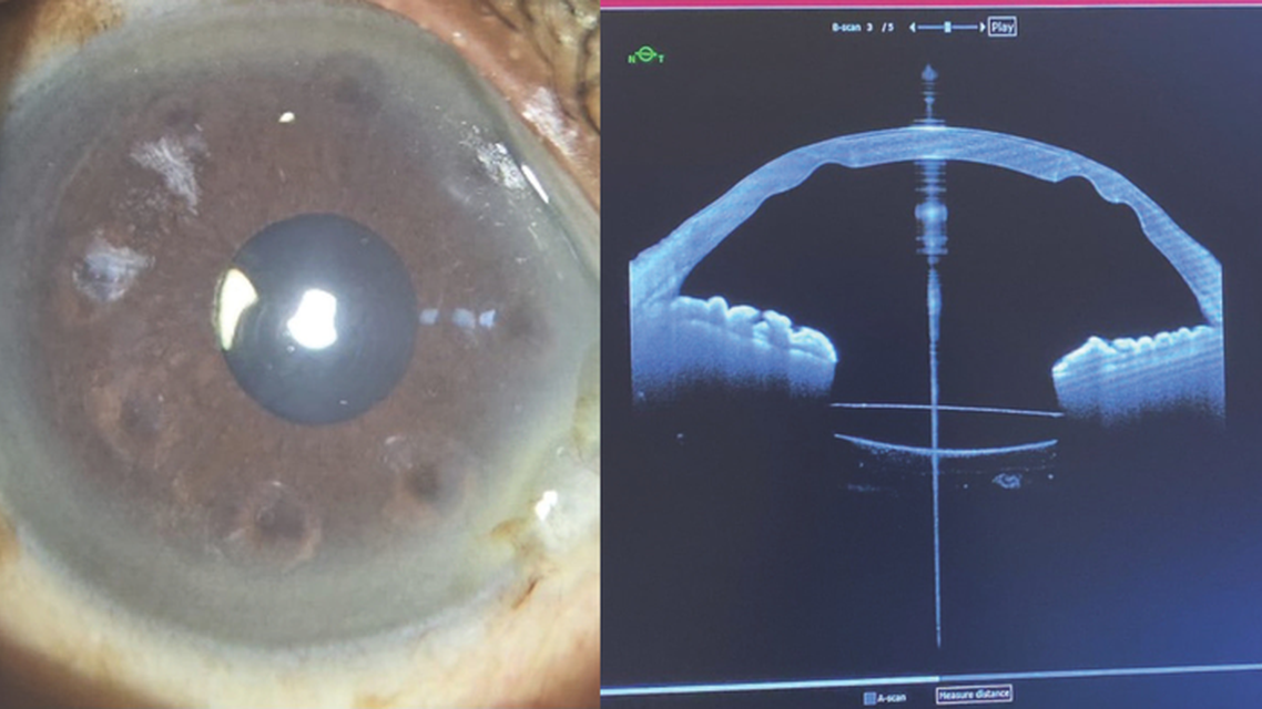 Atypical Corneal Flattening