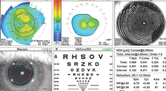 Cataract Management in a Young Adult With a Seizure Disorder