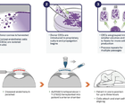Corneal Endothelial Cell Therapy
