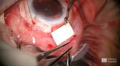 Tube Shunt Implantation Following Keratolimbal Graft thumbnail