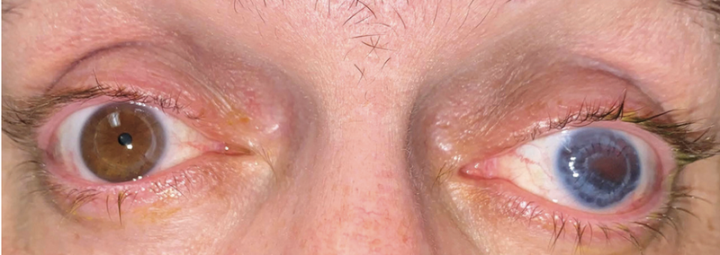 Combined PKP Artificial Iris and Secondary IOL Implantation for Corneal Scar Aniridia and Aphakia Post Traumatic Eye Inju