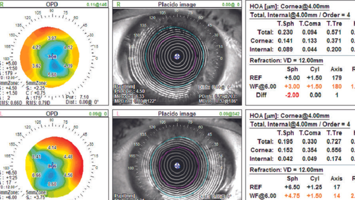 Cataracts and Russian Style Radial Keratotomy