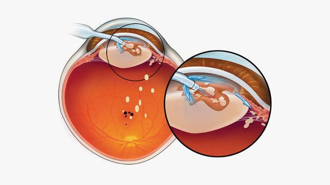 Improving Fluid Dynamics in Laser Cataract Surgery