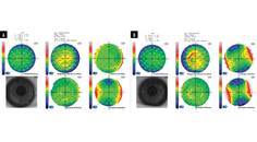 Visually Significant Cataract in the Presence of Corneal Disease