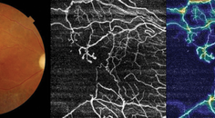 SS OCTA Proves Beneficial to Posterior Uveitis Management