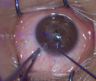 How to Master Small Incision Lenticule Extraction