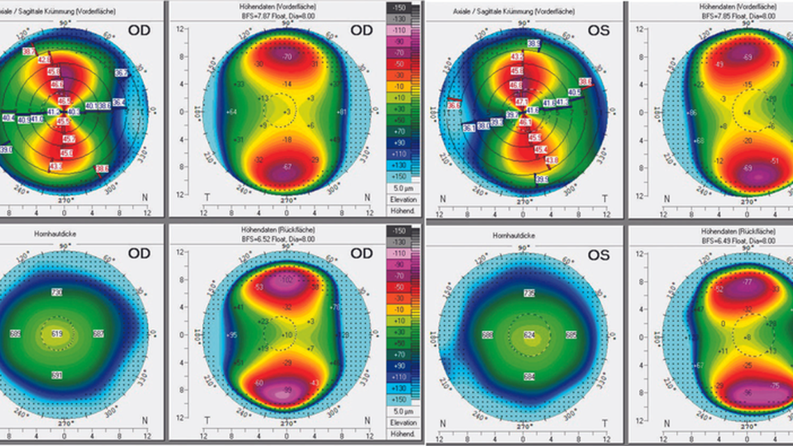 Extreme Astigmatism in a Pre Presbyopic Patient