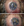 Figure 2. The donor graft cornea unscrolled properly to the right (A) but not to the left (B).