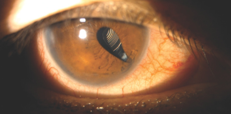 A Traumatically Dislocated but Perfectly Centered Multifocal IOL