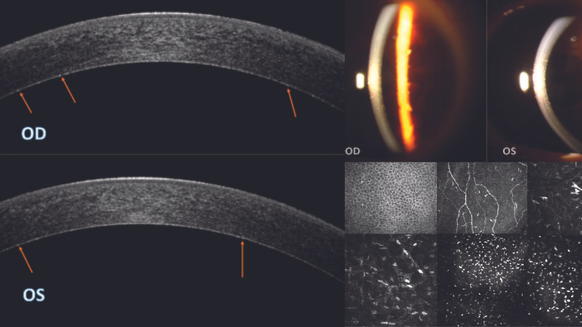 Punctiform and Polychromatic Pre Descemet Corneal Dystrophy