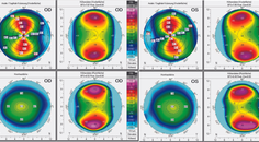 Extreme Astigmatism in a Pre Presbyopic Patient