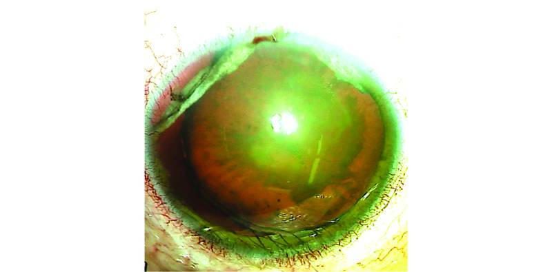 Posttraumatic Subluxated Cataract and Iris Defect
