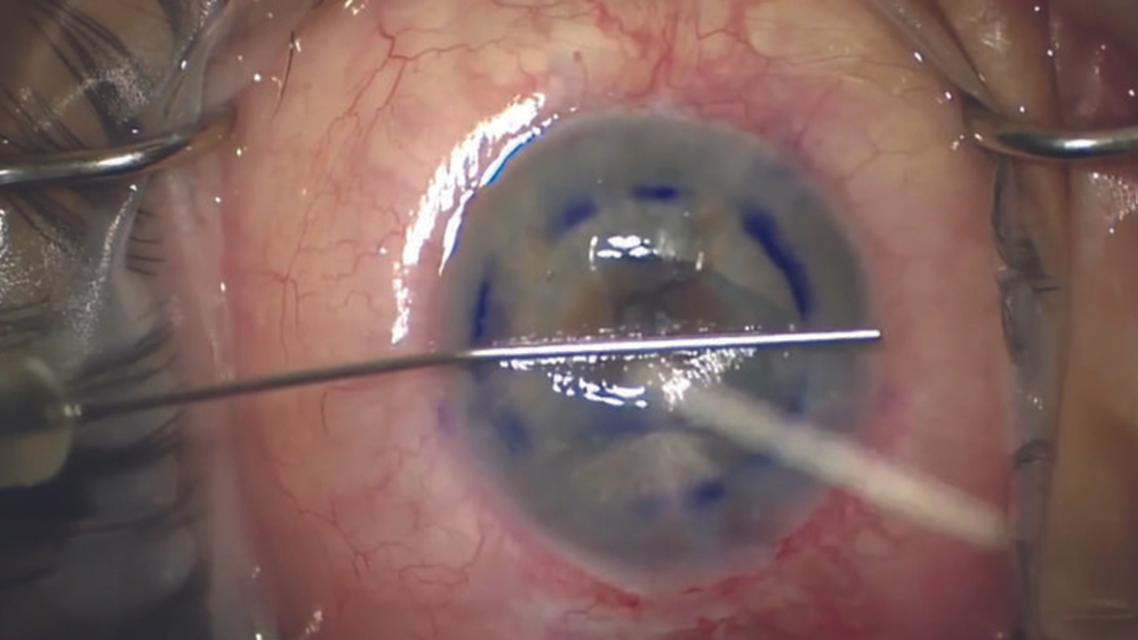 Simplifying DMEK With Intracameral Enoxaparin