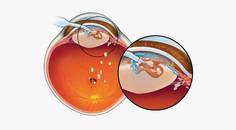 Improving Fluid Dynamics in Laser Cataract Surgery