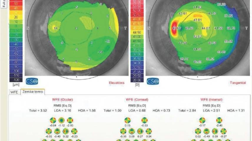 Monocular Diplopia Foggy Vision and Uncomfortable Binocular Vision