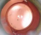 Indications for Posterior Capsulorhexis and Posterior Optic Capture