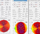 High Astigmatism and Amblyopia