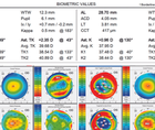 Satisfaction With a Trifocal IOL in One Eye Not Both