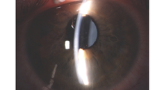 Excessive Vaulting of a Phakic IOL
