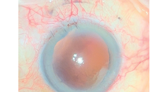 Traumatic Aphakia and Mydriasis