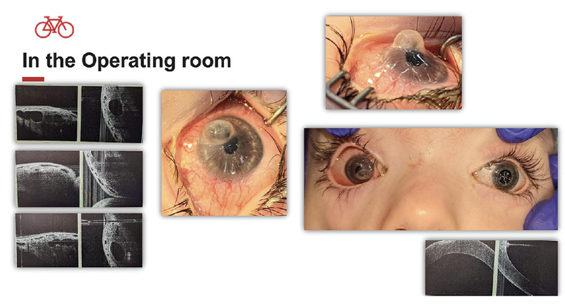 A Unique Case of Moraxella Keratitis in Moebius Syndrome
