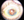 Figure 2. A Symfony OptiBlue IOL is centered in the capsular bag (B).