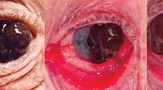 Conjunctival Melanoma