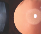 Nuclear Cataracts in a Young Adult