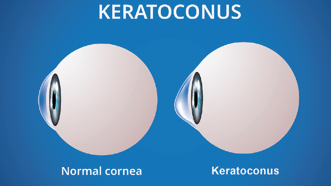 Severe Keratoconus and IOL Calculations