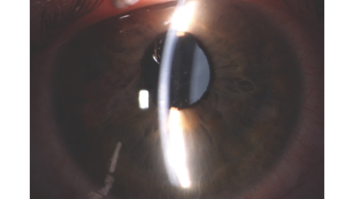 Excessive Vaulting of a Phakic IOL