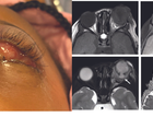 Endophthalmitis in a Patient With Presumed Axenfeld Rieger Syndrome