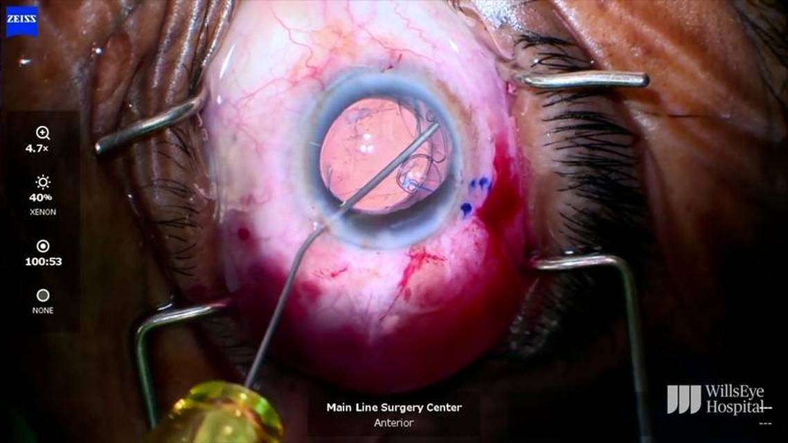 Prolene Suture Fixation of Capsular Tension Segment During Lens Exchange thumbnail