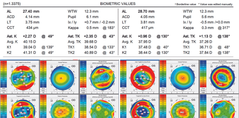 Satisfaction With a Trifocal IOL in One Eye Not Both