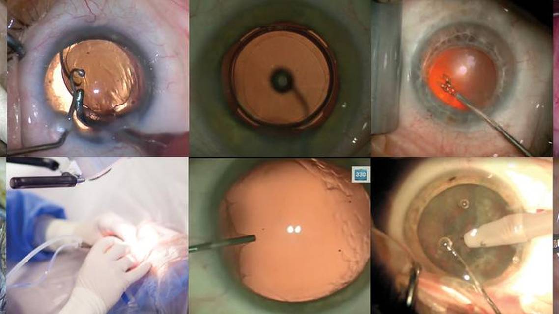 The European Perspective Innovation Simplifies Routine Cataract Surgery