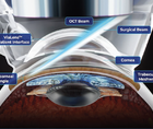 FLIGHT Femtosecond Laser Image Guided High Precision Trabeculotomy