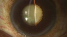 Dislocated Mature Black Cataract