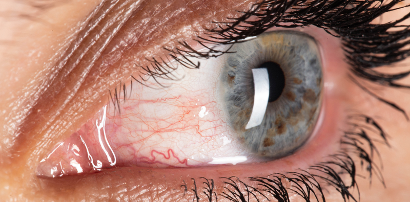 Targeting Inflammation in Dry Eye Disease