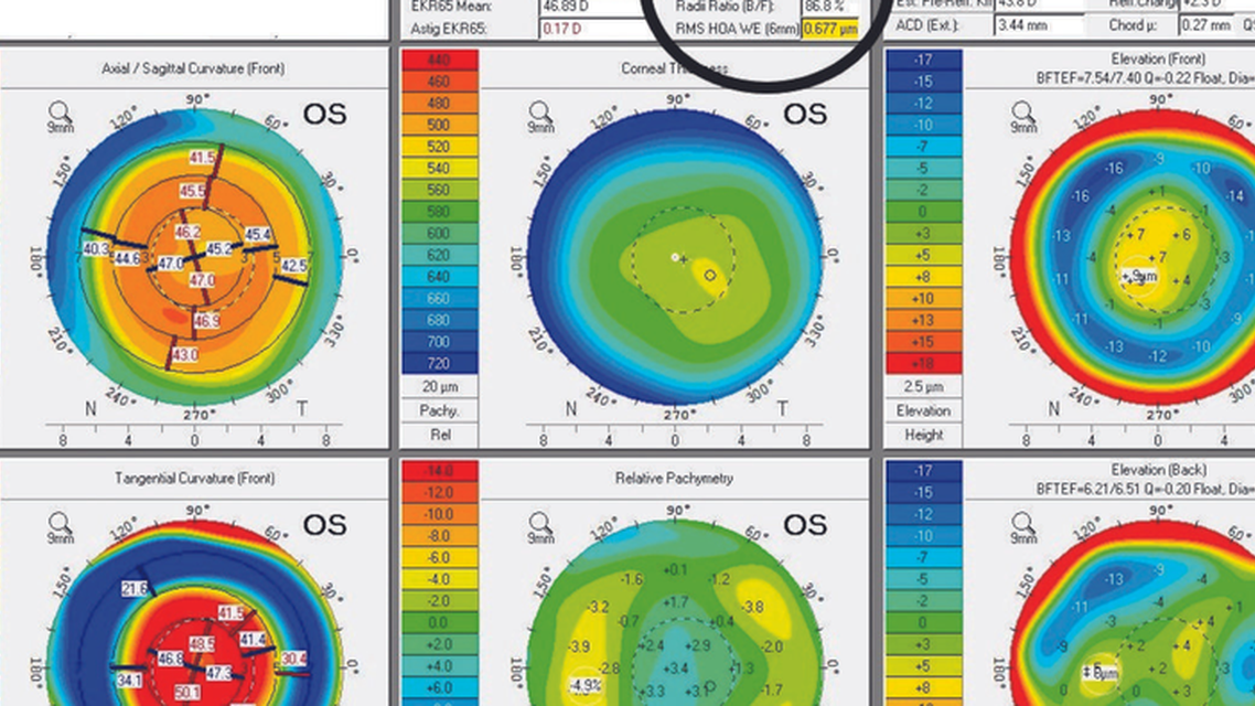 Cataracts After Monovision LASIK
