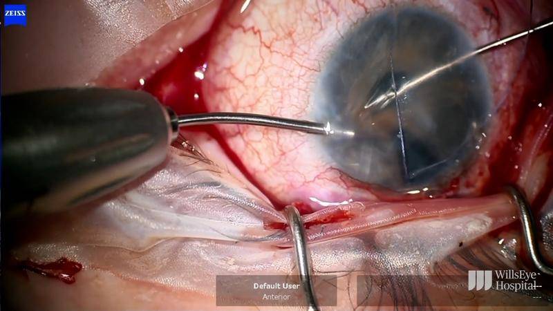 Tube Exchange in Uncontrolled Glaucoma thumbnail