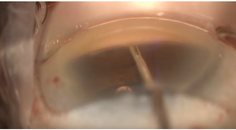 Hand in Hand MIGS and Advanced Refractive Cataract Surgery