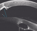 Intrastromal Corneal Ring Segment Erosion Into the Anterior Chamber