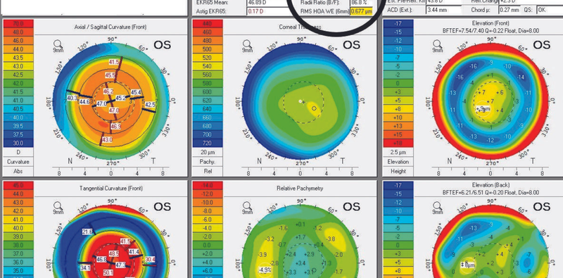 Cataracts After Monovision LASIK