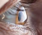 Pearls for Keratoconus Screening and Treatment
