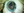 Figure 6. After implantation of the IOL, Dr. Ayres restained the capsular bag with trypan blue dye to improve visualization during placement of the CustomFlex ArtificialIris.