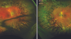 IOL Subluxation in the Presence of Retinal Disease