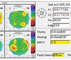 Improved Visual Outcomes With LACRIFILL Canalicular Gel Assisted Ocular Surface Optimization